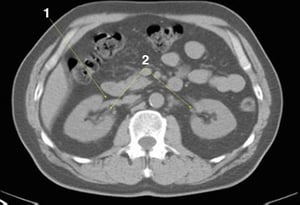 Tomografía computarizada sin contraste de abdomen y pelvis que muestra anatomía normal (imagen 14)