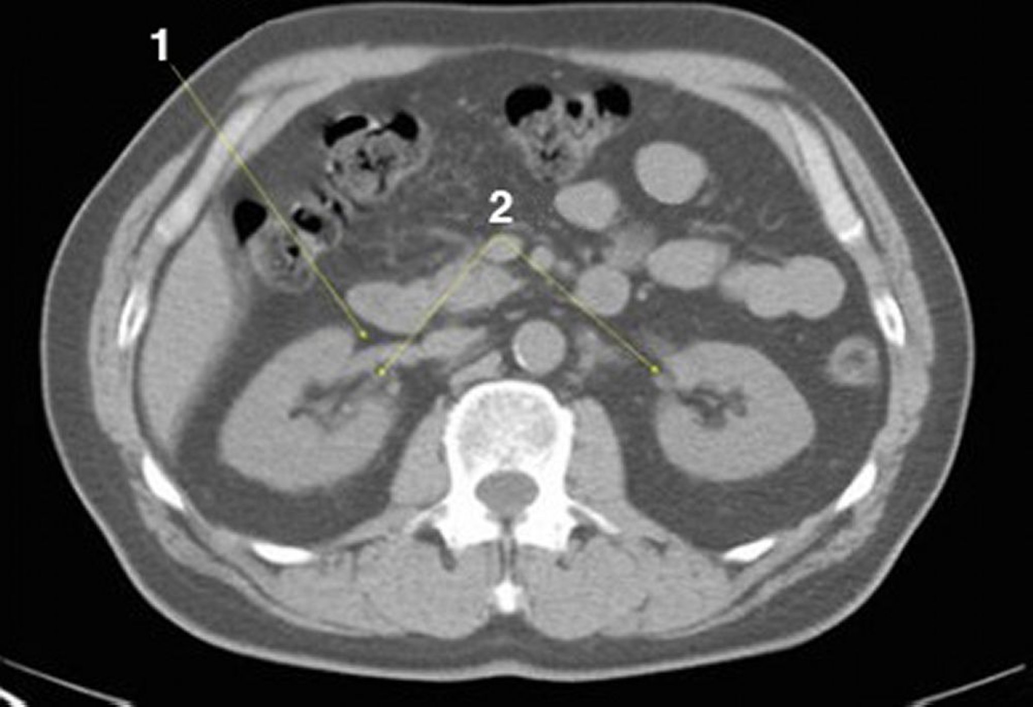 TDM sans contraste de l'abdomen et du bassin montrant une anatomie normale (diapositive 14)