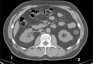 Tomografía computarizada sin contraste de abdomen y pelvis que muestra anatomía normal (corte 15)