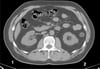 TDM sans contraste de l'abdomen et du bassin montrant une anatomie normale (diapositive 15)
