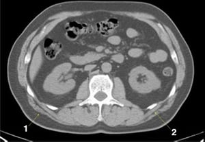 Phim chụp CT vùng bụng và xương chậu không thuốc cản quang cho thấy giải phẫu bình thường (lát cắt 15)