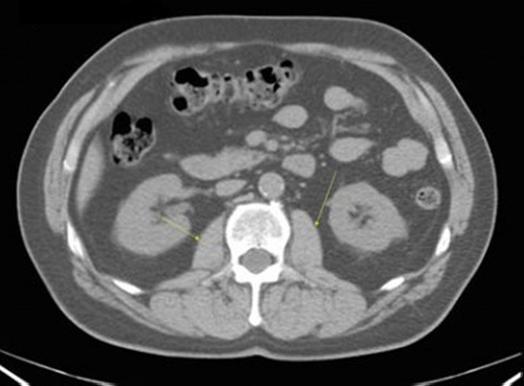 Noncontrast CT Scan of the Abdomen and Pelvis Showing Normal Anatomy (Slide 18)