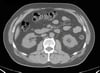 TDM sans contraste de l'abdomen et du bassin montrant une anatomie normale (diapositive 16)
