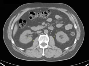 TDM sans contraste de l'abdomen et du bassin montrant une anatomie normale (diapositive 16)