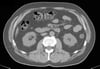 TDM sans contraste de l'abdomen et du bassin montrant une anatomie normale (diapositive 17)