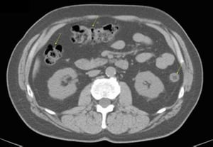 TDM sans contraste de l'abdomen et du bassin montrant une anatomie normale (diapositive 17)