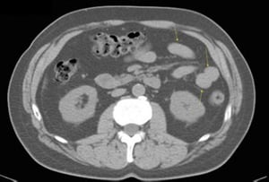 CT-Scan von Abdomen und Becken mit normaler Anatomie ohne Kontrastmittel (Folie 20)