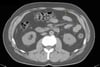 Tomografía computarizada sin contraste de abdomen y pelvis que muestra anatomía normal (corte 20)