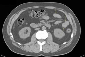TDM sans contraste de l'abdomen et du bassin montrant une anatomie normale (diapositive 18)