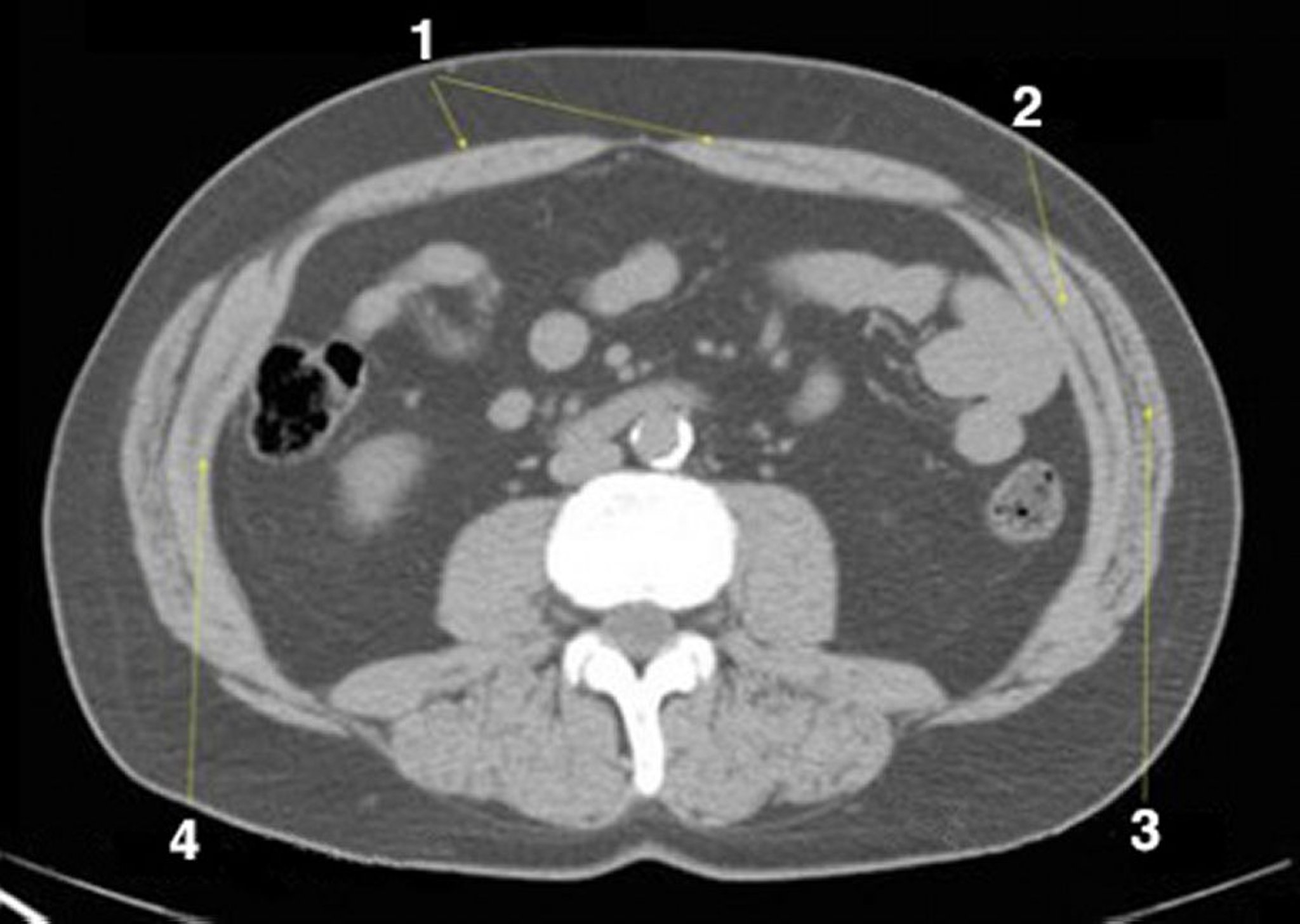 腹部和骨盆的非增强 CT 扫描显示正常解剖结构（幻灯片 19）