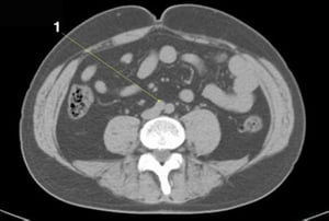 Phim chụp CT vùng bụng và xương chậu không thuốc cản quang cho thấy giải phẫu bình thường (lát cắt 20)