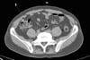 TDM sans contraste de l'abdomen et du bassin montrant une anatomie normale (diapositive 21)