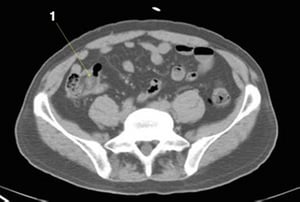 Phim chụp CT vùng bụng và xương chậu không thuốc cản quang cho thấy giải phẫu bình thường (lát cắt 21)