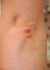 Xantoma tuberoso