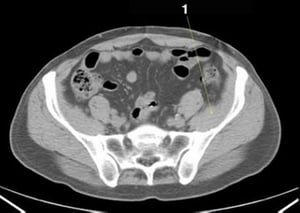 Tomografía computarizada sin contraste de abdomen y pelvis que muestra anatomía normal (corte 22)