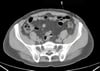 TDM sans contraste de l'abdomen et du bassin montrant une anatomie normale (diapositive 22)