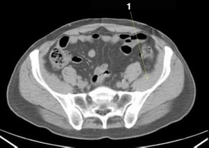 Phim chụp CT vùng bụng và xương chậu không thuốc cản quang cho thấy giải phẫu bình thường (lát cắt 22)