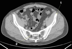 Tomografía computarizada sin contraste de abdomen y pelvis que muestra anatomía normal (corte 23)