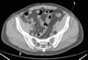 TDM sans contraste de l'abdomen et du bassin montrant une anatomie normale (diapositive 23)