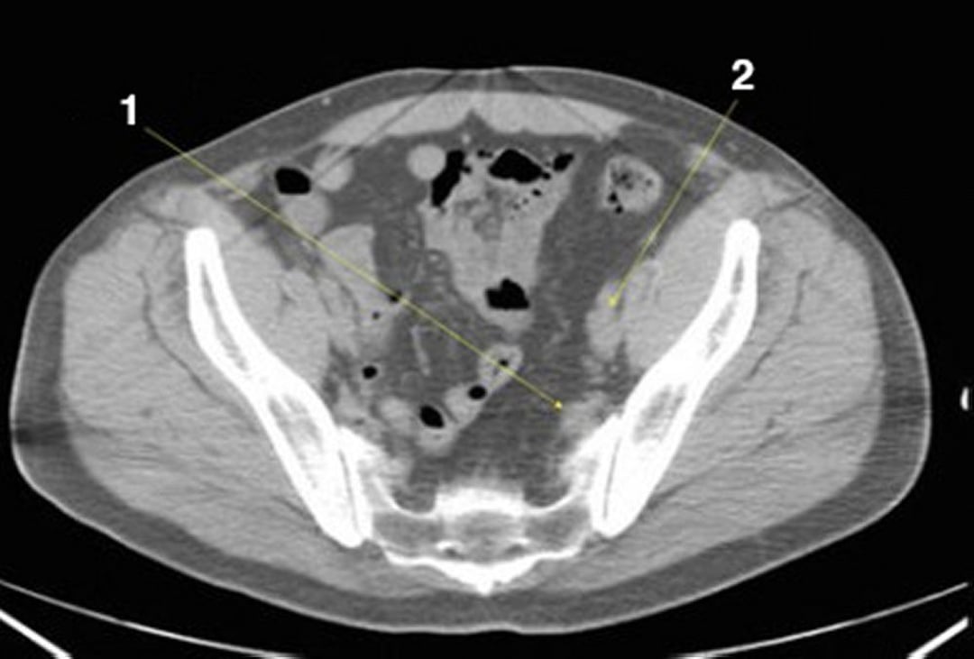 Image:Noncontrast CT Scan of the Abdomen and Pelvis Showing Normal ...