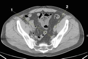 CT-Scan von Abdomen und Becken mit normaler Anatomie ohne Kontrastmittel (Folie 24)