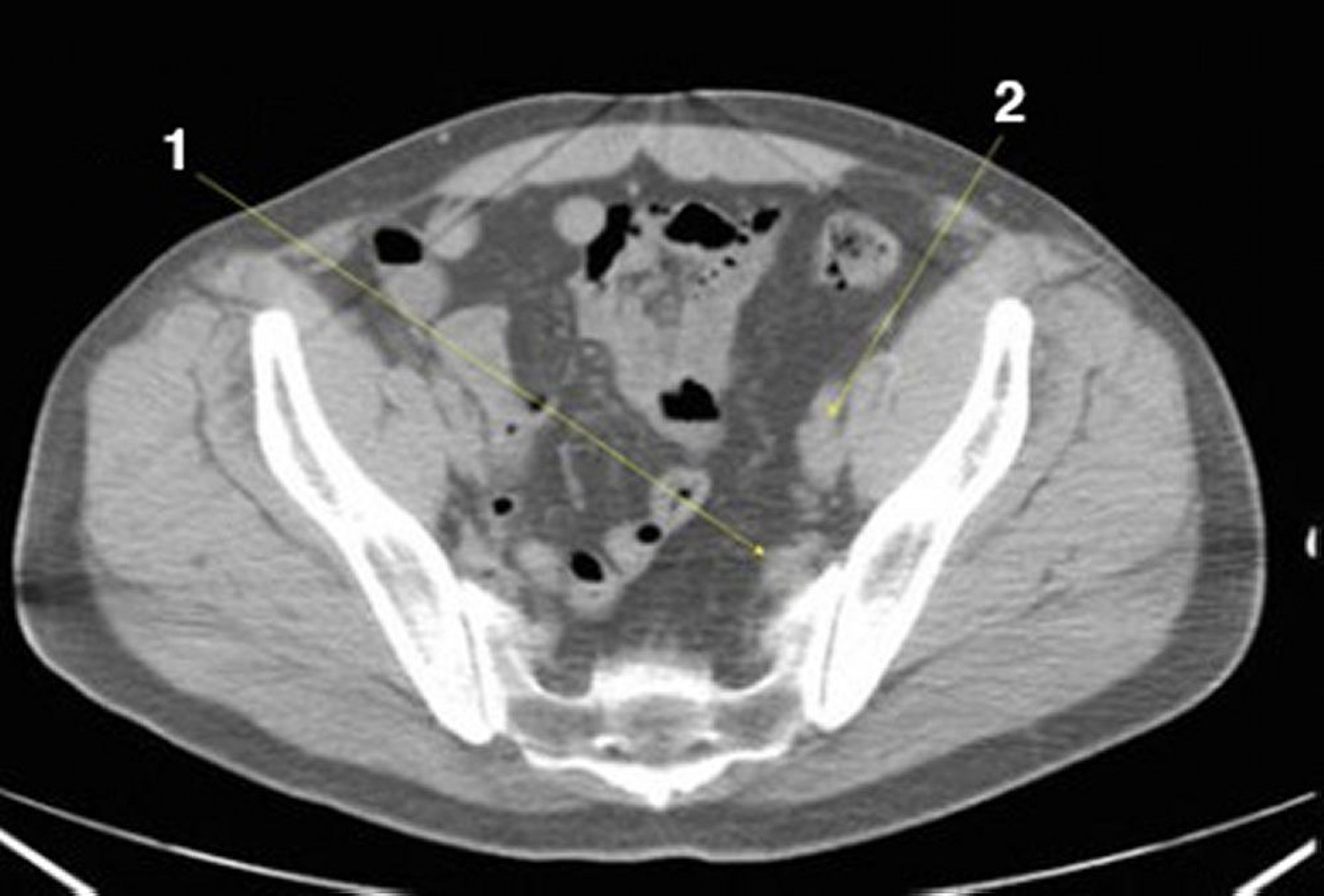 TDM sans contraste de l'abdomen et du bassin montrant une anatomie normale (diapositive 24)