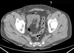Tomografía computarizada sin contraste de abdomen y pelvis que muestra anatomía normal (corte 25)