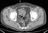 TDM sans contraste de l'abdomen et du bassin montrant une anatomie normale (diapositive 26)