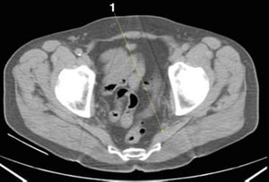 Phim chụp CT vùng bụng và xương chậu không thuốc cản quang cho thấy giải phẫu bình thường (lát cắt 26)