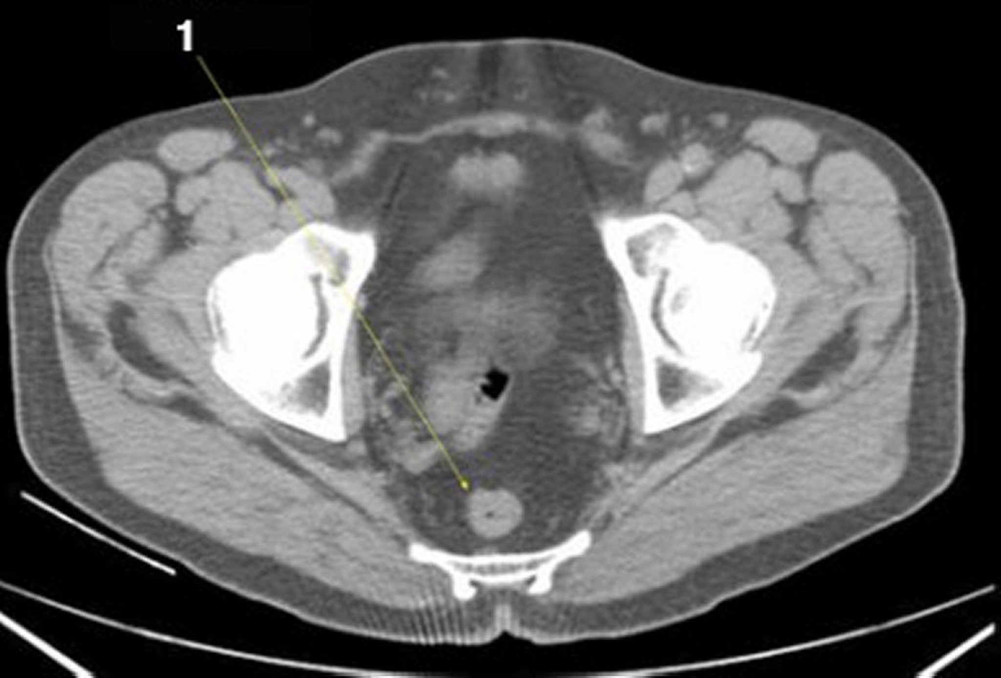 TDM sans contraste de l'abdomen et du bassin montrant une anatomie normale (diapositive 27)