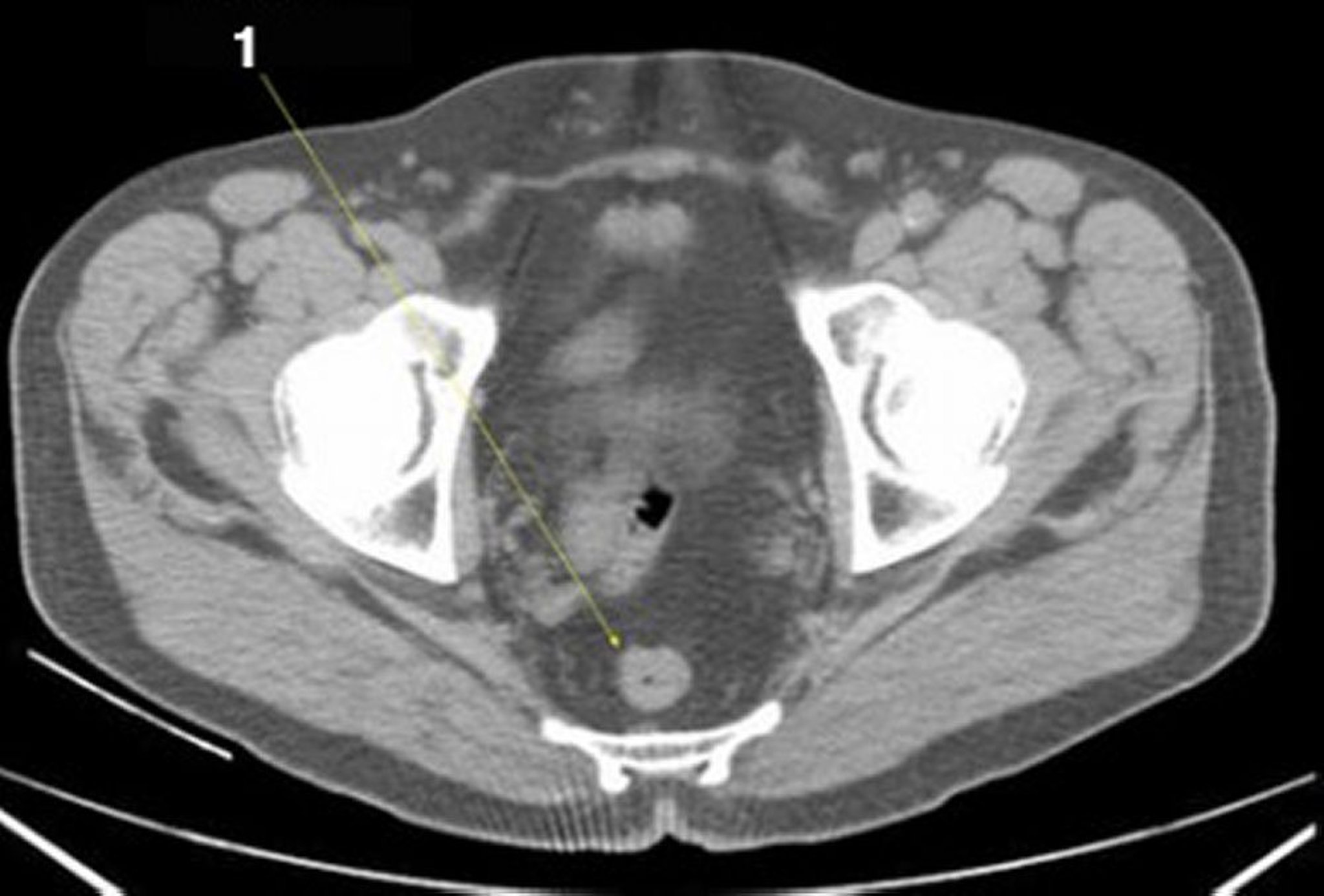 腹部和骨盆的非增强 CT 扫描显示正常解剖结构（幻灯片 27）