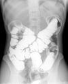 Enema de bario con doble contraste que muestra anatomía normal