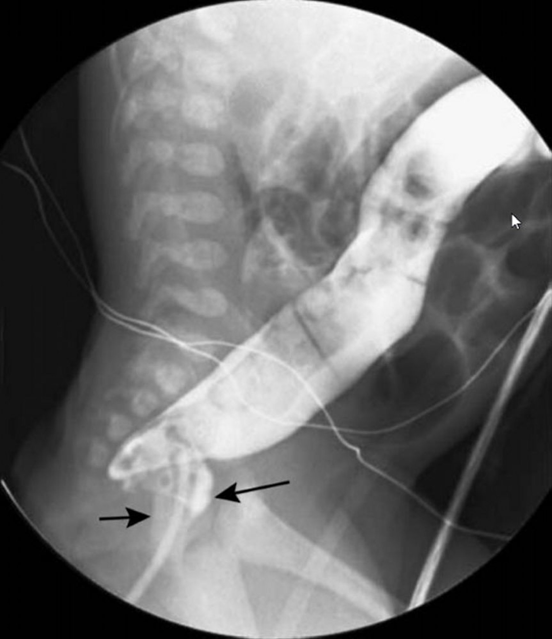 Enema de bario con un solo medio de contraste que muestra el aspecto en cuello de cisne de la enfermedad de Hirschsprung