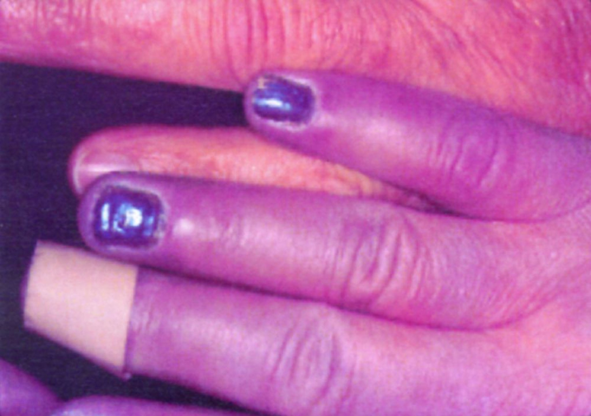 Acrocianosis en una mano