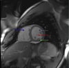 Cardiac MRI Showing Normal Cardiac Anatomy