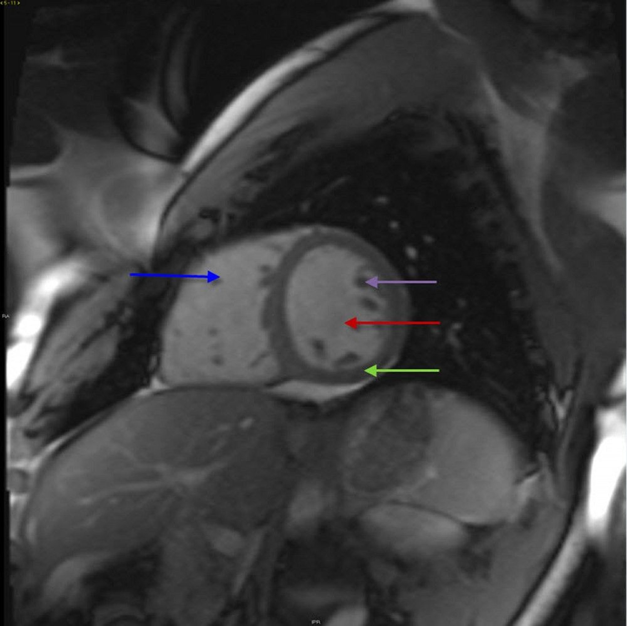 Cardiac MRI Showing Normal Cardiac Anatomy