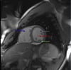 Resonancia magnética cardíaca que muestra una anatomía cardíaca normal