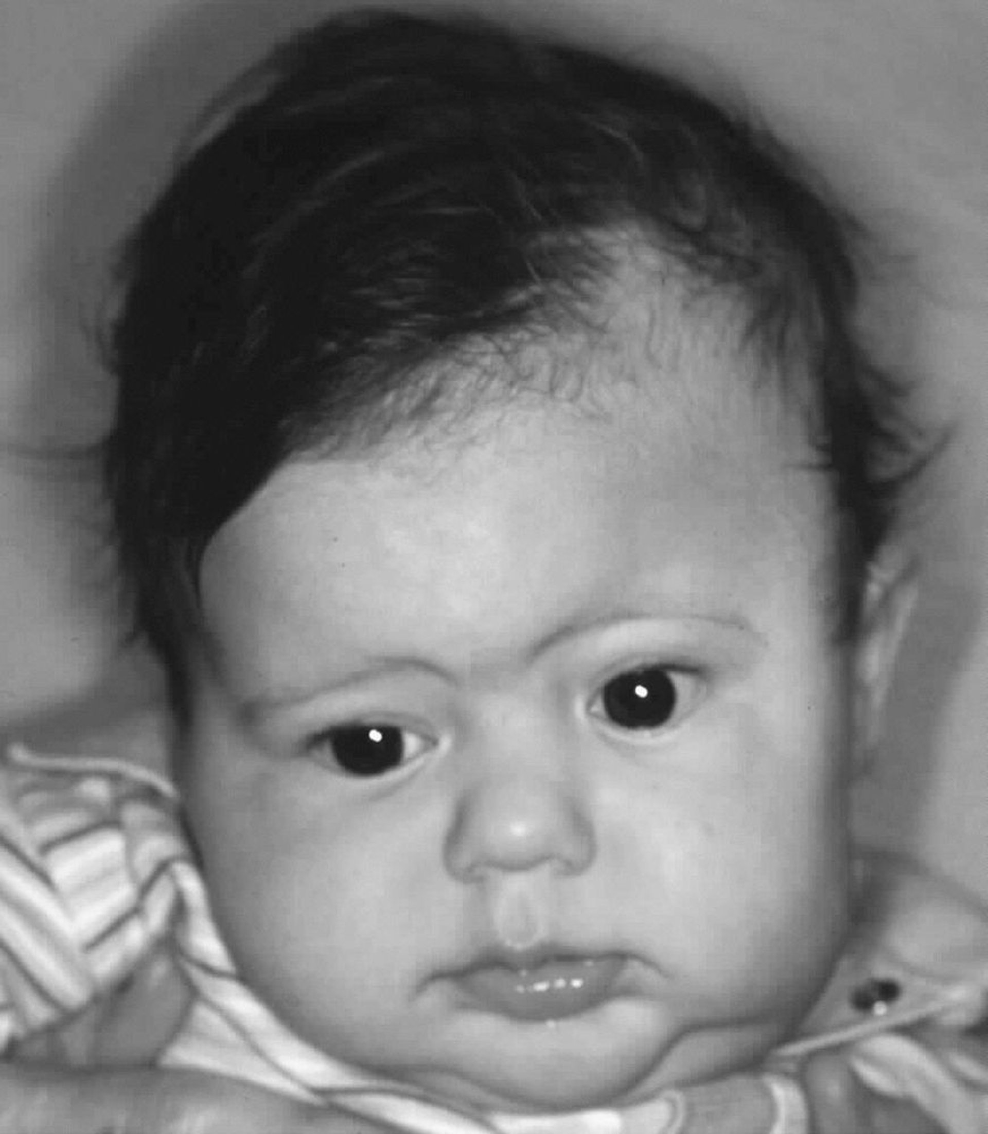 Левый коронарный краниосиностоз