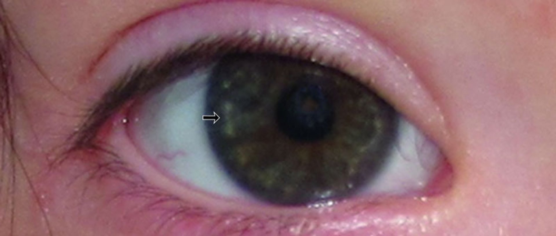 Down Syndrome (Brushfield Spots)