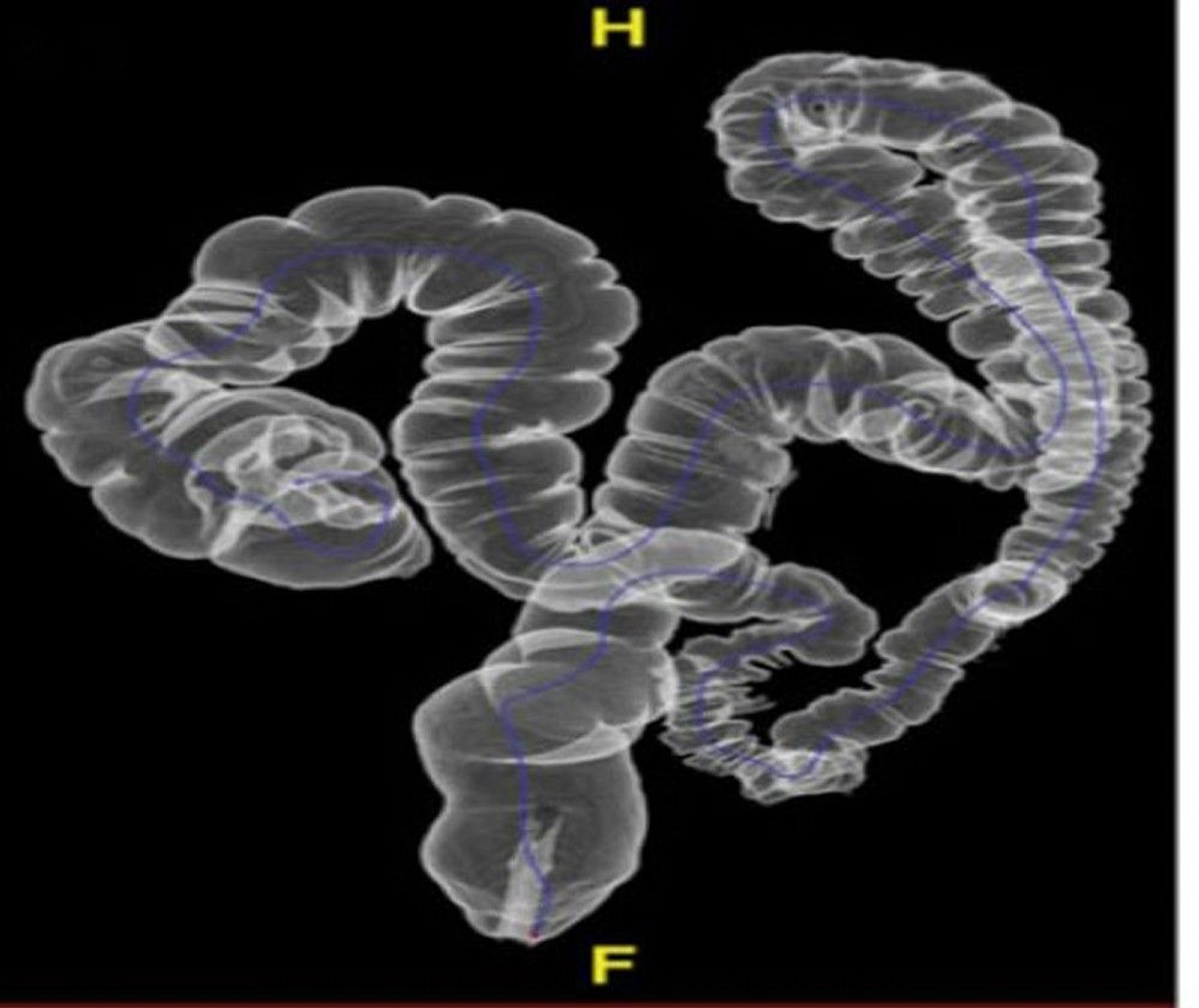 CT Colonography Showing Normal Anatomy