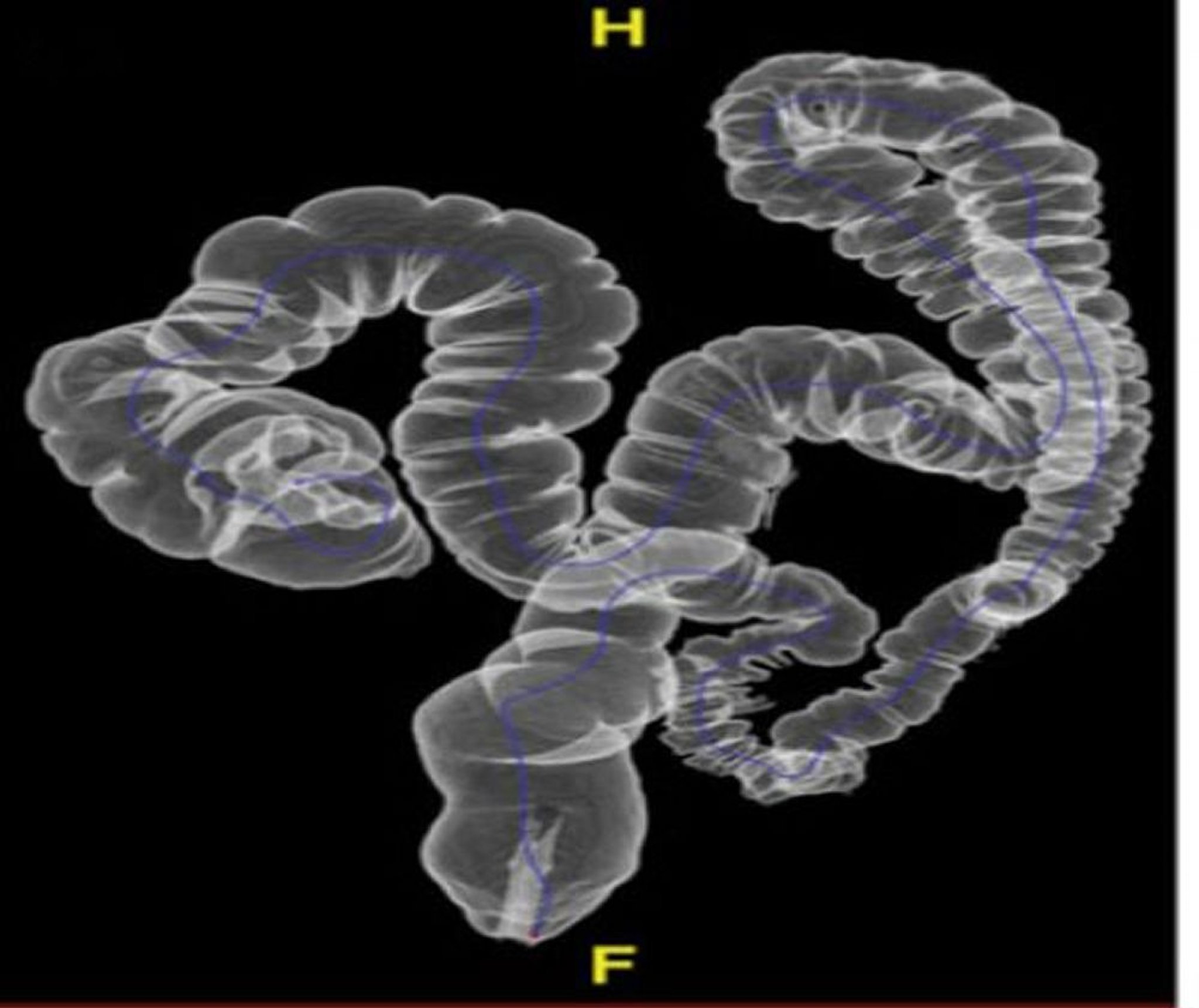 Colonografia TC che mostra un'anatomia normale
