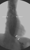 Transit baryté montrant un œsophage dilaté avec un aspect étroit en forme de bec au niveau du sphincter inférieur de l'œsophage