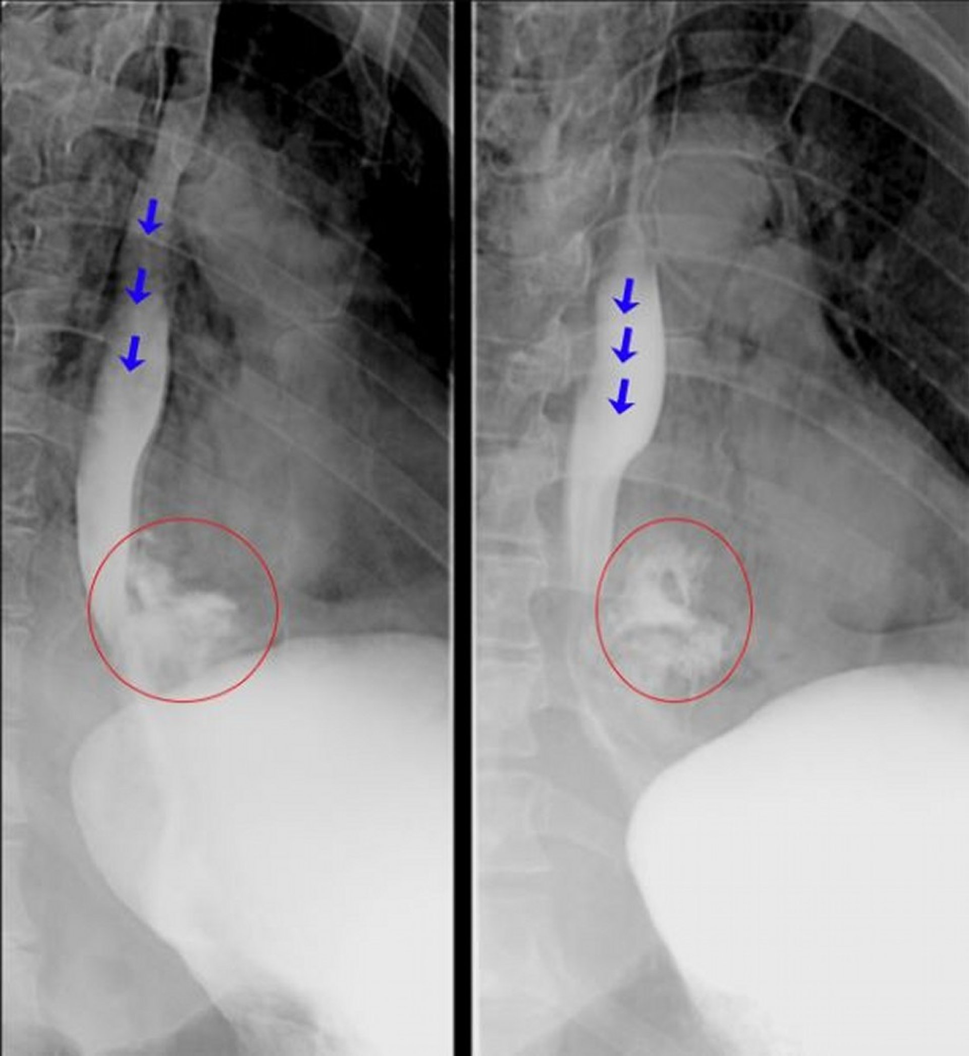 Esophagography with Water-Soluble Contrast