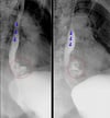 Esophagography with Water-Soluble Contrast