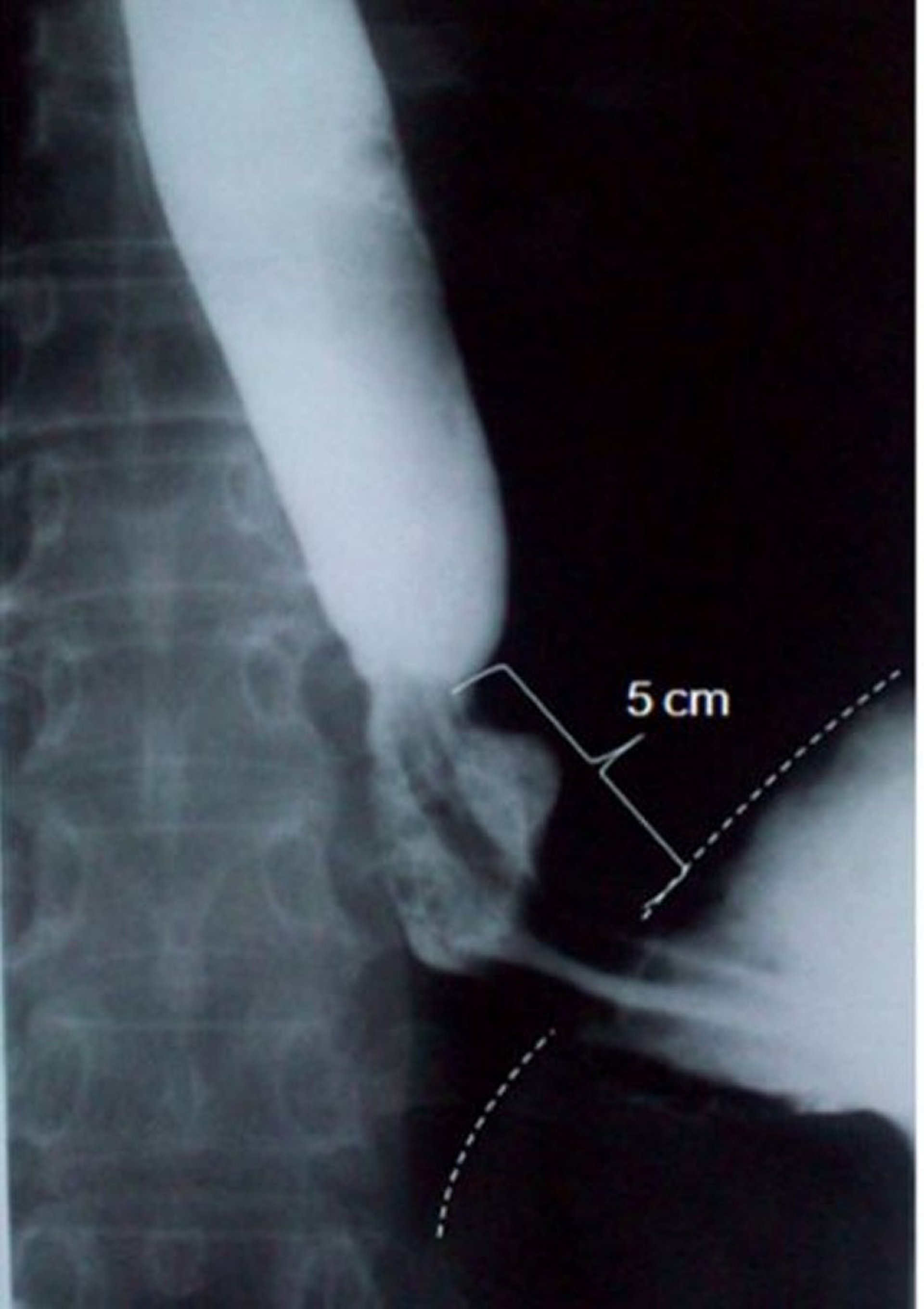 Barium Swallow Showing Sliding Hiatus Hernia