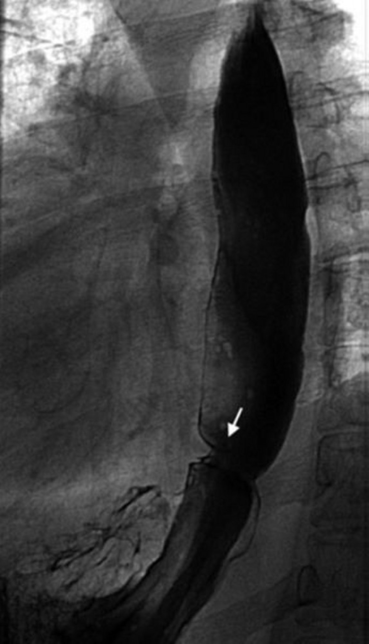 Barium Swallow Showing Esophageal Ring