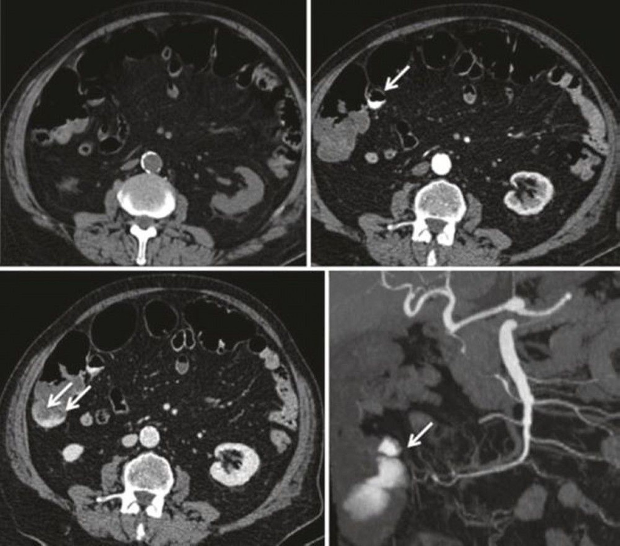 CT Angiography Showing Gastrointestinal Bleed