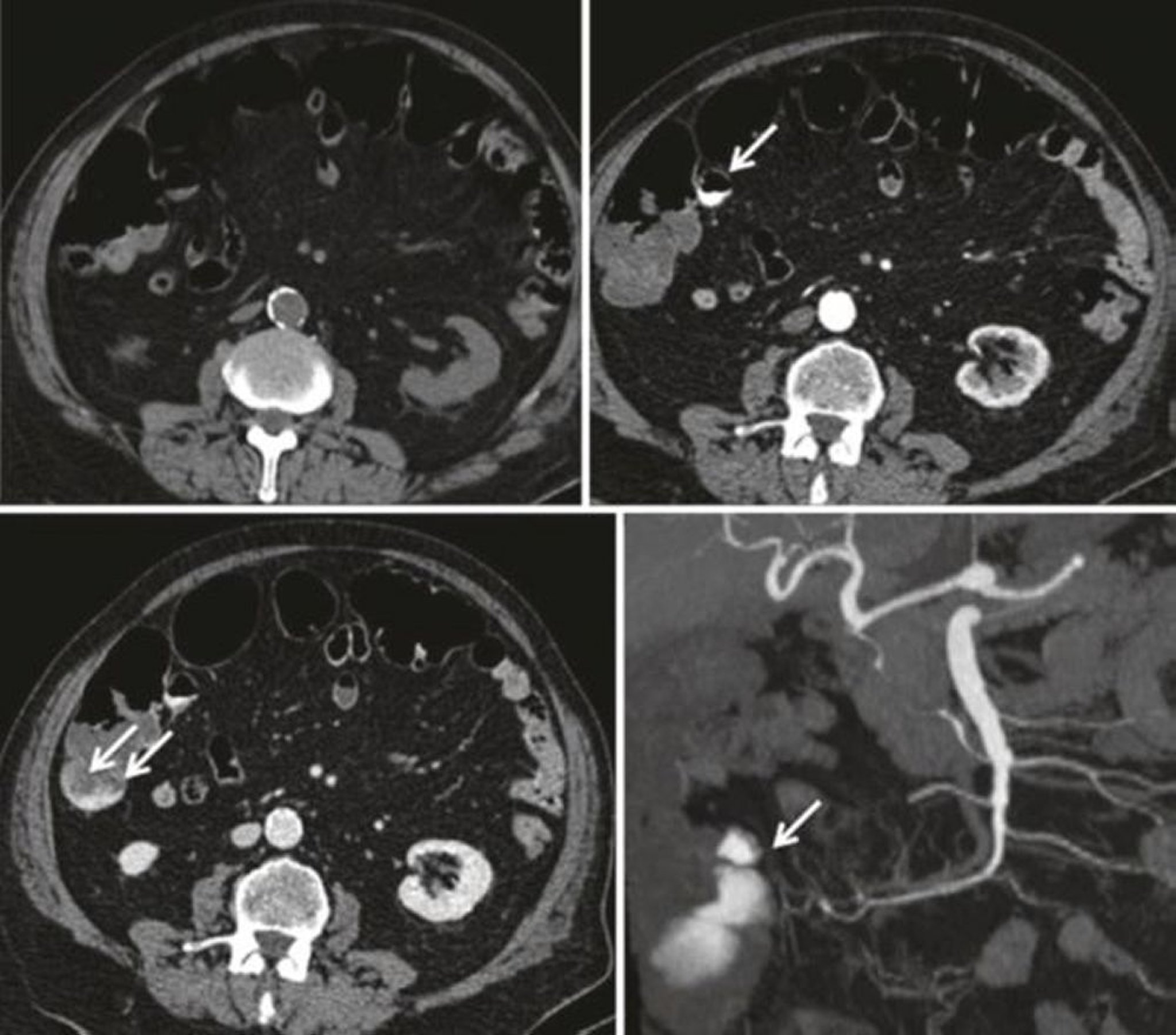 Angiografía por TC que muestra sangrado gastrointestinal