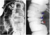 Colon por enema que muestra una úlcera en la pared del colon