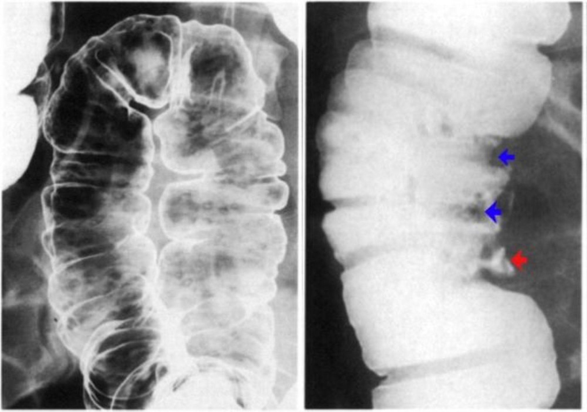 Enema baritado mostrando ulceração da parede do colo intestinal